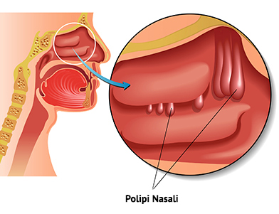 polipi nasali